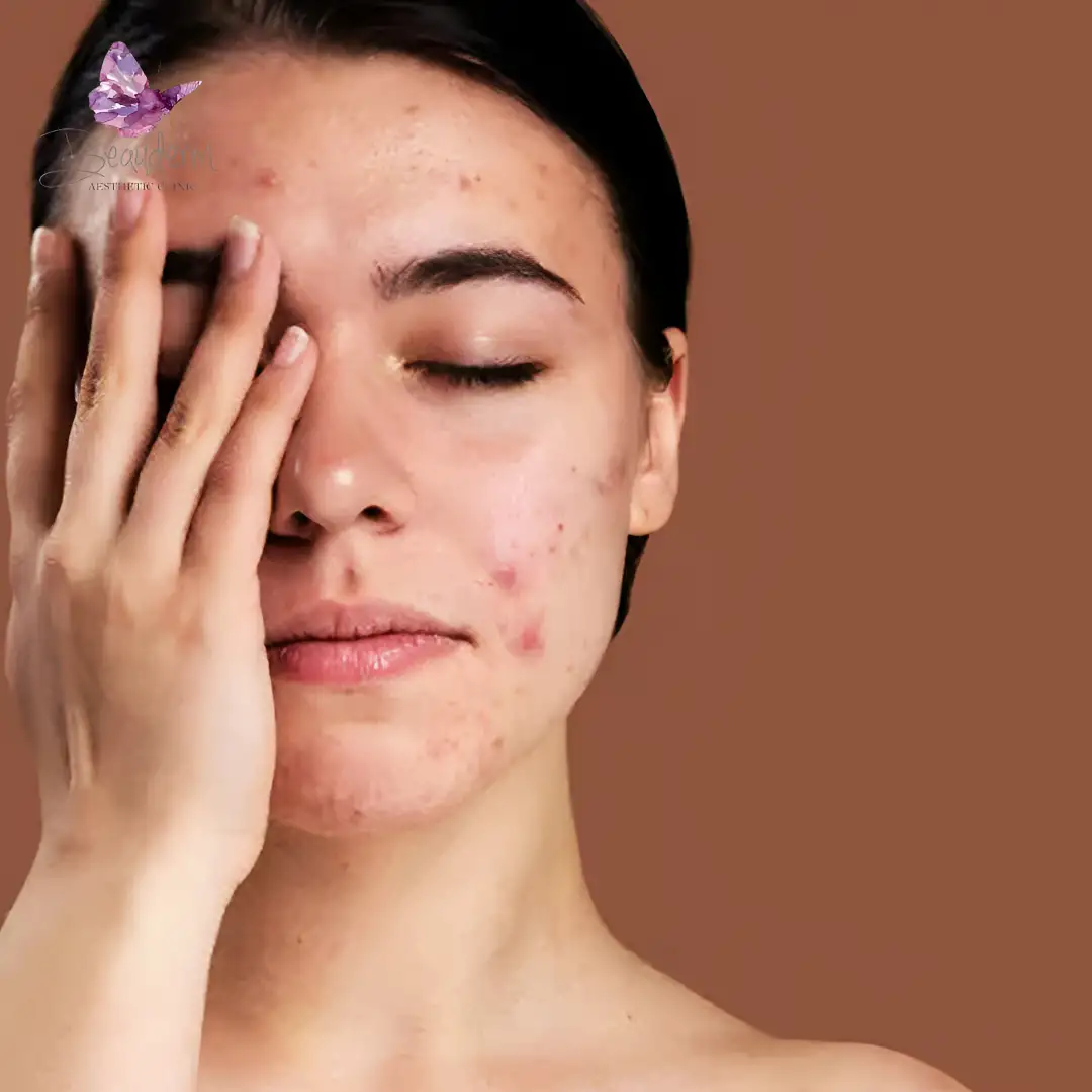 Atasi Flek Dengan Skinbooster
